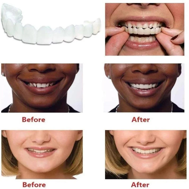 Instant Smile Reusable Snap On Veneers (Upper & Lower)